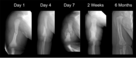 Humerus (arm bone)