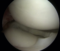 Meniscal resection
