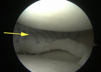 Meniscal Stabilisation