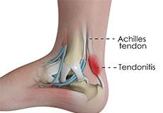 Achilles Tendinitis 