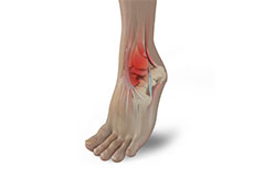 Acute Foot & Ankle Injury