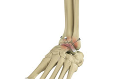 Ankle Fusion Surgery