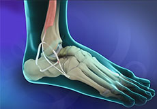 Ankle ligament Stabilisation