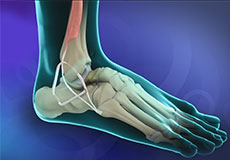 Ankle Ligament Reconstruction