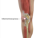 Bursitis