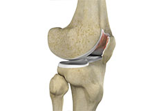 Chondromalacia Patella