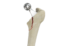 Femur Fracture