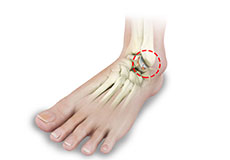 Foot and Ankle Arthritis