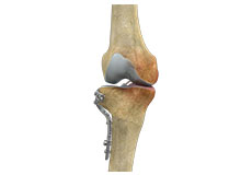 High Tibial Osteotomy