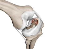 Meniscal Injuries & Tears