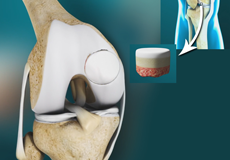 Osteochondritis Dissecans (OCD)