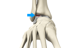 Ankle Injury (OCD)