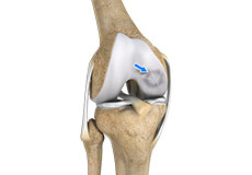 Osteochondral Defects