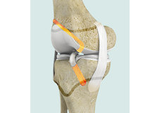 Paediatric ACL Reconstructin