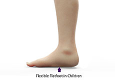 Paediatric Flexible Flatfoot