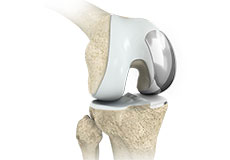 Unicompartmental Knee Replacement/ Partial Knee Replacement