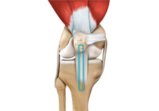 ACL Reconstruction Patellar Tendon