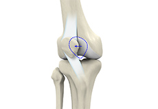 Patellofemoral Dislocation