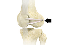 Patellofemoral Stabilisation