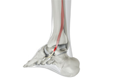 Posterior Tibial Tendon Dysfunction