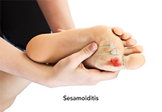 Sesamoiditis