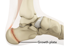 Sever's Disease