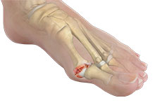 Stiff Big Toe (Hallux Rigidus) 