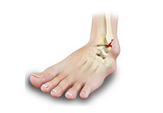 Stress Fractures of the Foot