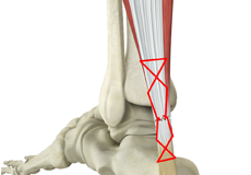 Surgery for a Torn Achilles Tendon