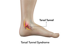 Tarsal Tunnel Syndrome