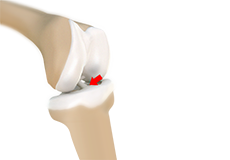 Tibial Spine Avulsion